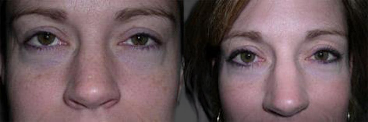 TCA Peel / Dermabrasion Before & After Gallery - Patient 326529 - Image 3