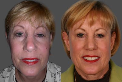TCA Peel / Dermabrasion Before & After Gallery - Patient 320810 - Image 1