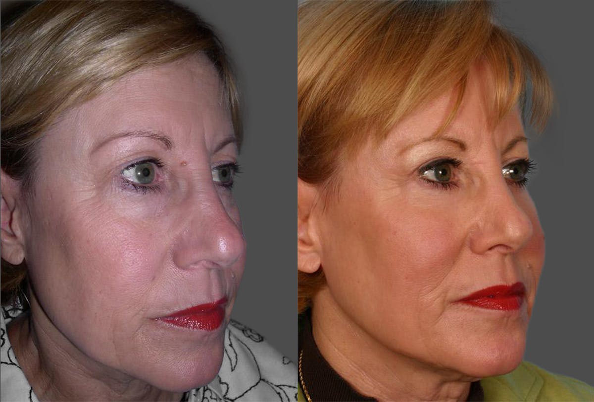 TCA Peel / Dermabrasion Before & After Gallery - Patient 320810 - Image 2