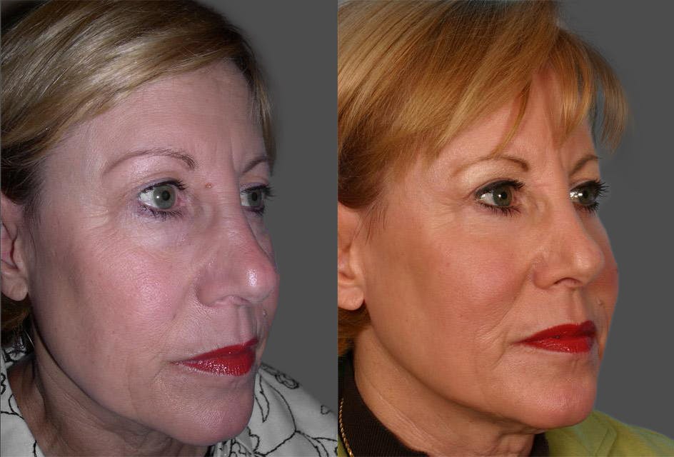 TCA Peel / Dermabrasion Before & After Gallery - Patient 320810 - Image 2