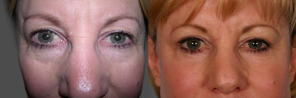 TCA Peel / Dermabrasion Before & After Gallery - Patient 320810 - Image 3