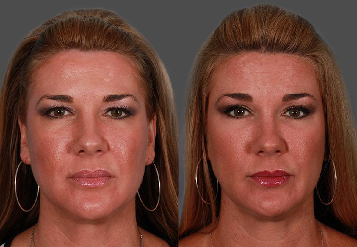 TCA Peel / Dermabrasion Before & After Gallery - Patient 319055 - Image 1
