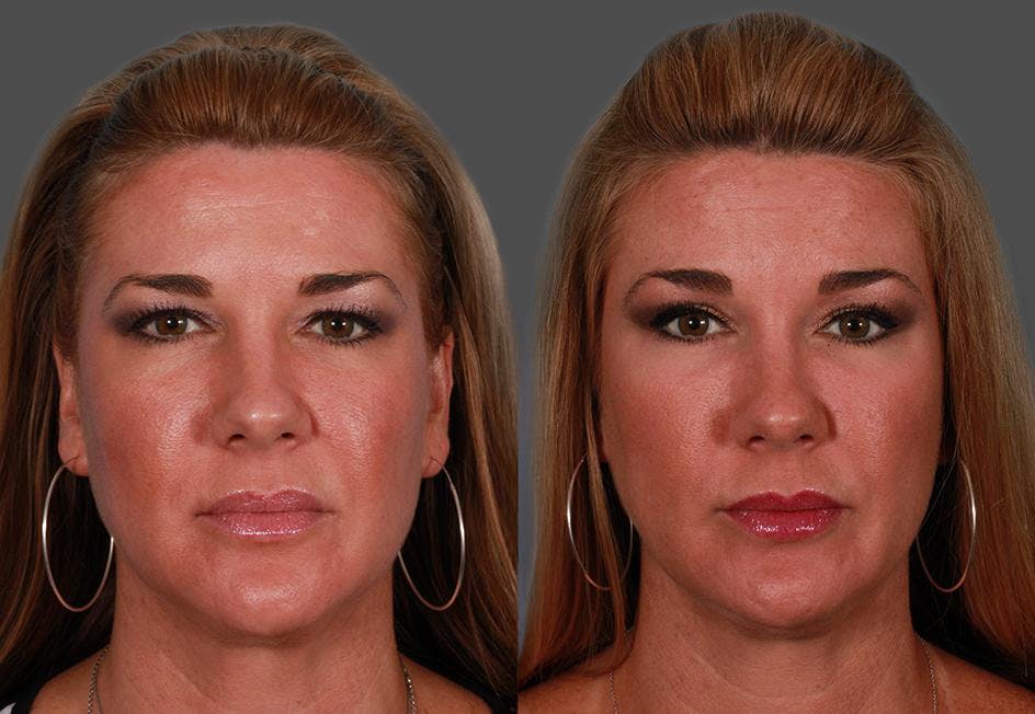 TCA Peel / Dermabrasion Before & After Gallery - Patient 319055 - Image 1