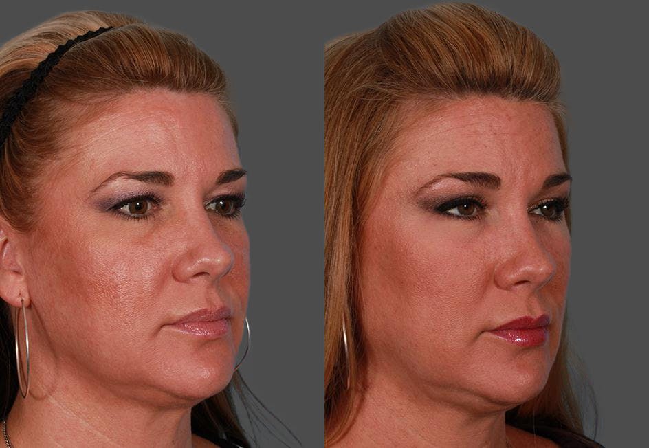 TCA Peel / Dermabrasion Before & After Gallery - Patient 319055 - Image 2