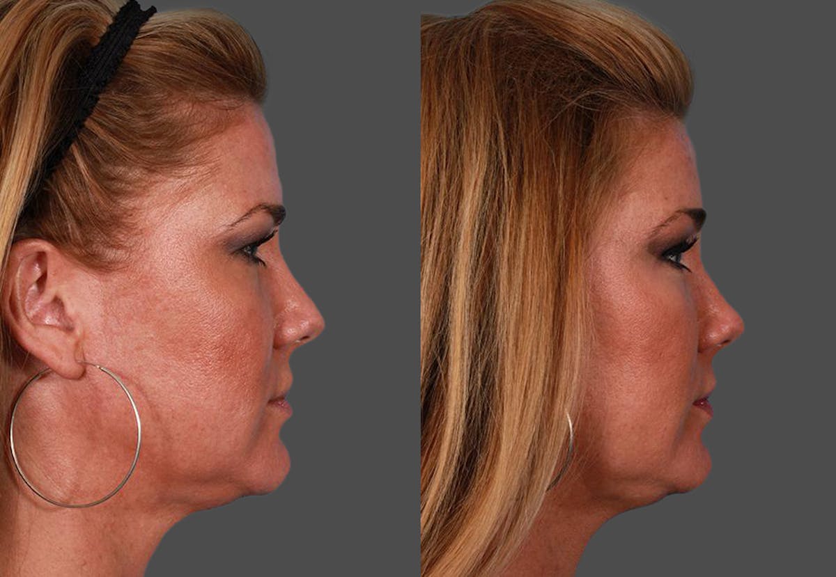 TCA Peel / Dermabrasion Before & After Gallery - Patient 319055 - Image 3