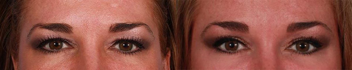 TCA Peel / Dermabrasion Before & After Gallery - Patient 319055 - Image 4
