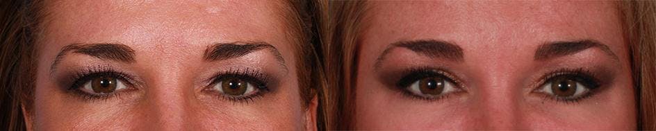 TCA Peel / Dermabrasion Before & After Gallery - Patient 319055 - Image 4