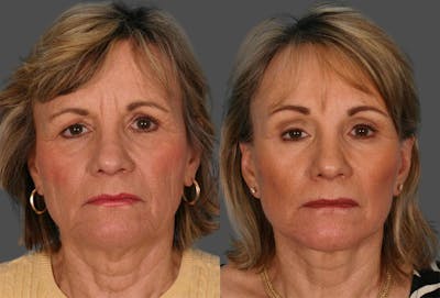 TCA Peel / Dermabrasion Before & After Gallery - Patient 226118 - Image 1