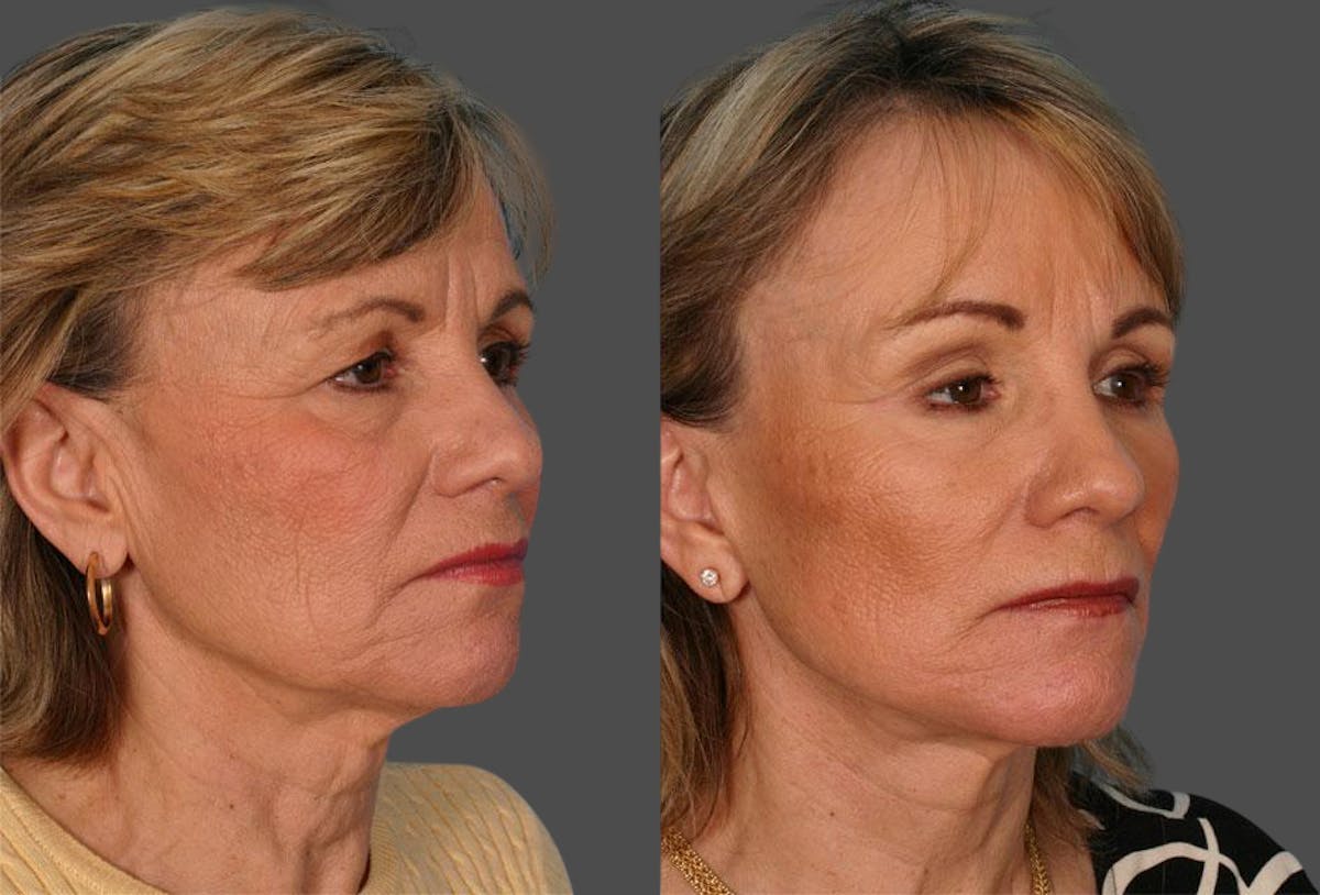 TCA Peel / Dermabrasion Before & After Gallery - Patient 226118 - Image 2