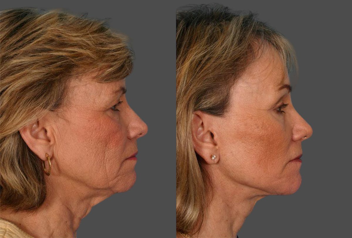 TCA Peel / Dermabrasion Before & After Gallery - Patient 226118 - Image 3