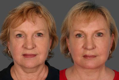 TCA Peel / Dermabrasion Before & After Gallery - Patient 191560 - Image 1