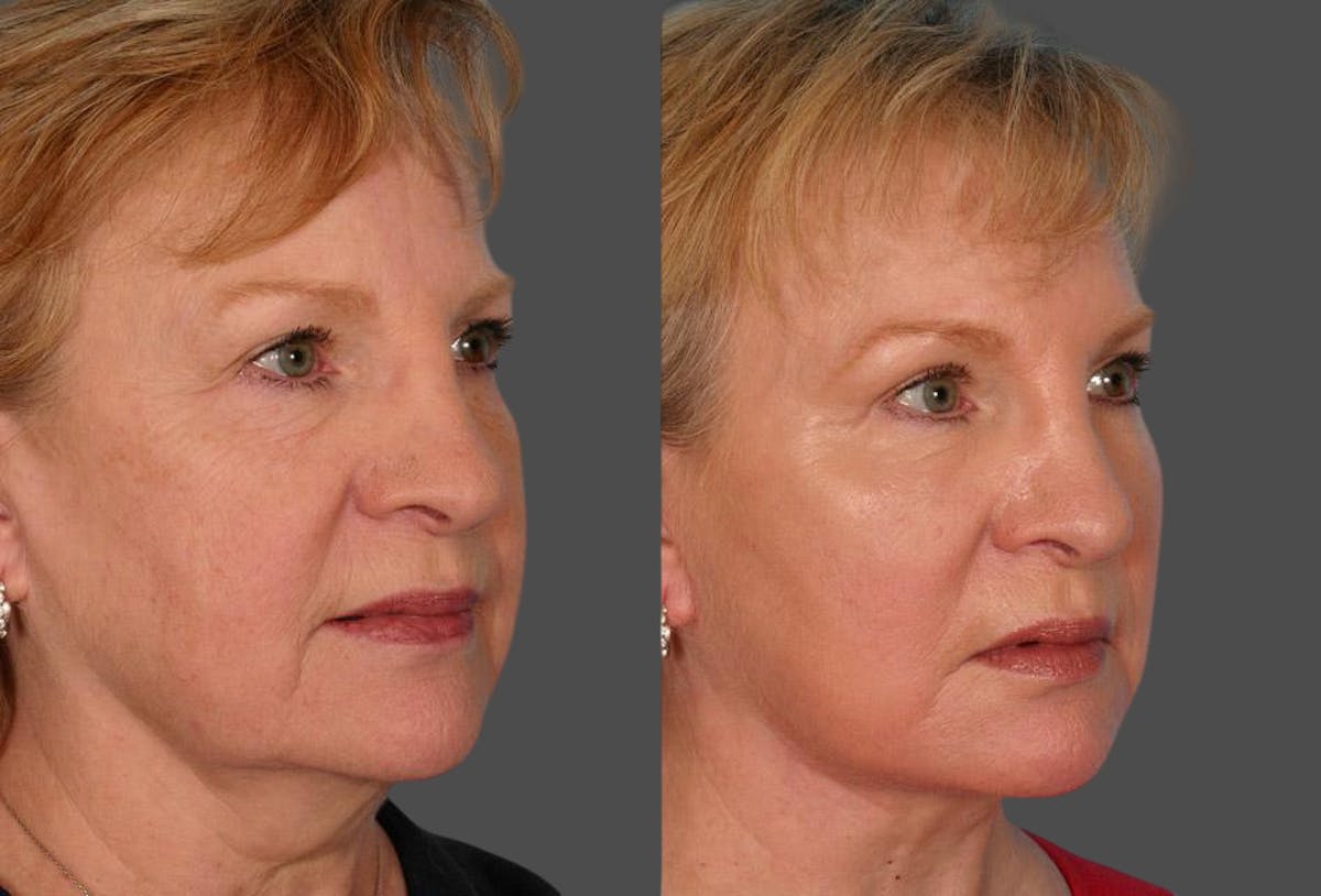 TCA Peel / Dermabrasion Before & After Gallery - Patient 191560 - Image 2