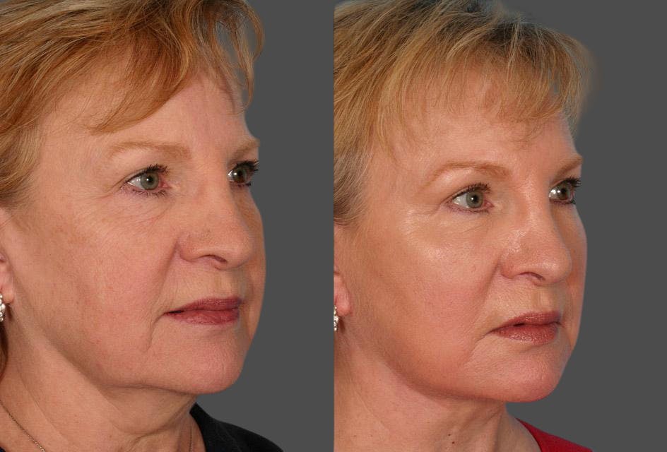 TCA Peel / Dermabrasion Before & After Gallery - Patient 191560 - Image 2