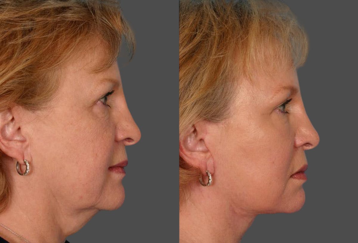 TCA Peel / Dermabrasion Before & After Gallery - Patient 191560 - Image 3