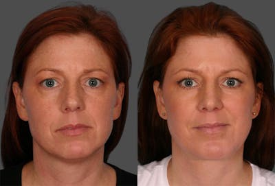 TCA Peel / Dermabrasion Before & After Gallery - Patient 163908 - Image 1