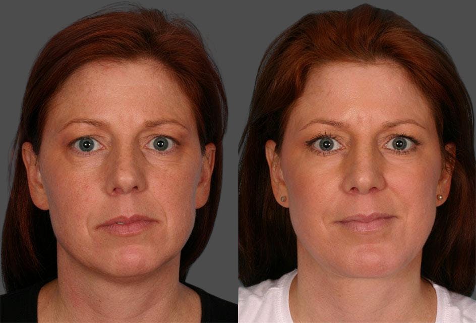 TCA Peel / Dermabrasion Before & After Gallery - Patient 163908 - Image 1