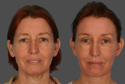 TCA Peel / Dermabrasion Before & After Gallery - Patient 141969 - Image 1