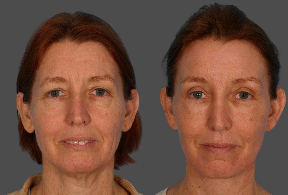 TCA Peel / Dermabrasion Before & After Gallery - Patient 141969 - Image 1