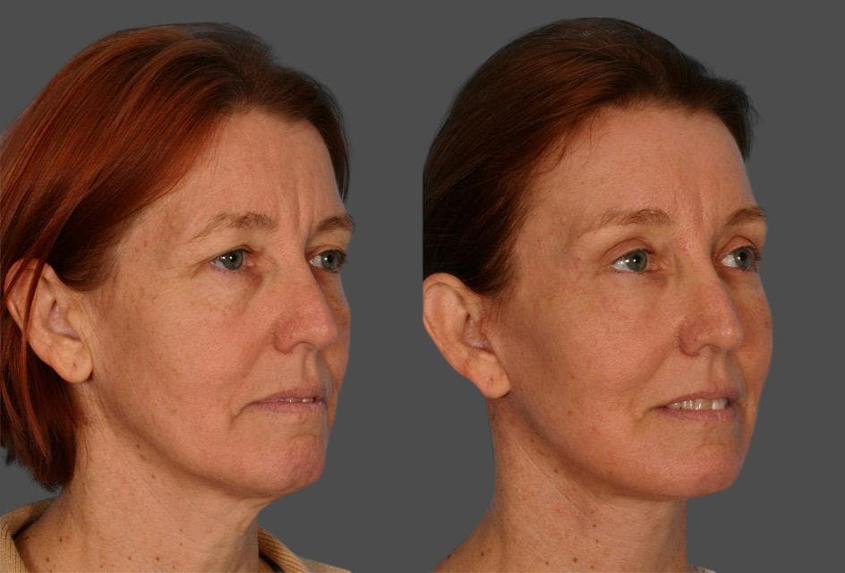 TCA Peel / Dermabrasion Before & After Gallery - Patient 141969 - Image 2