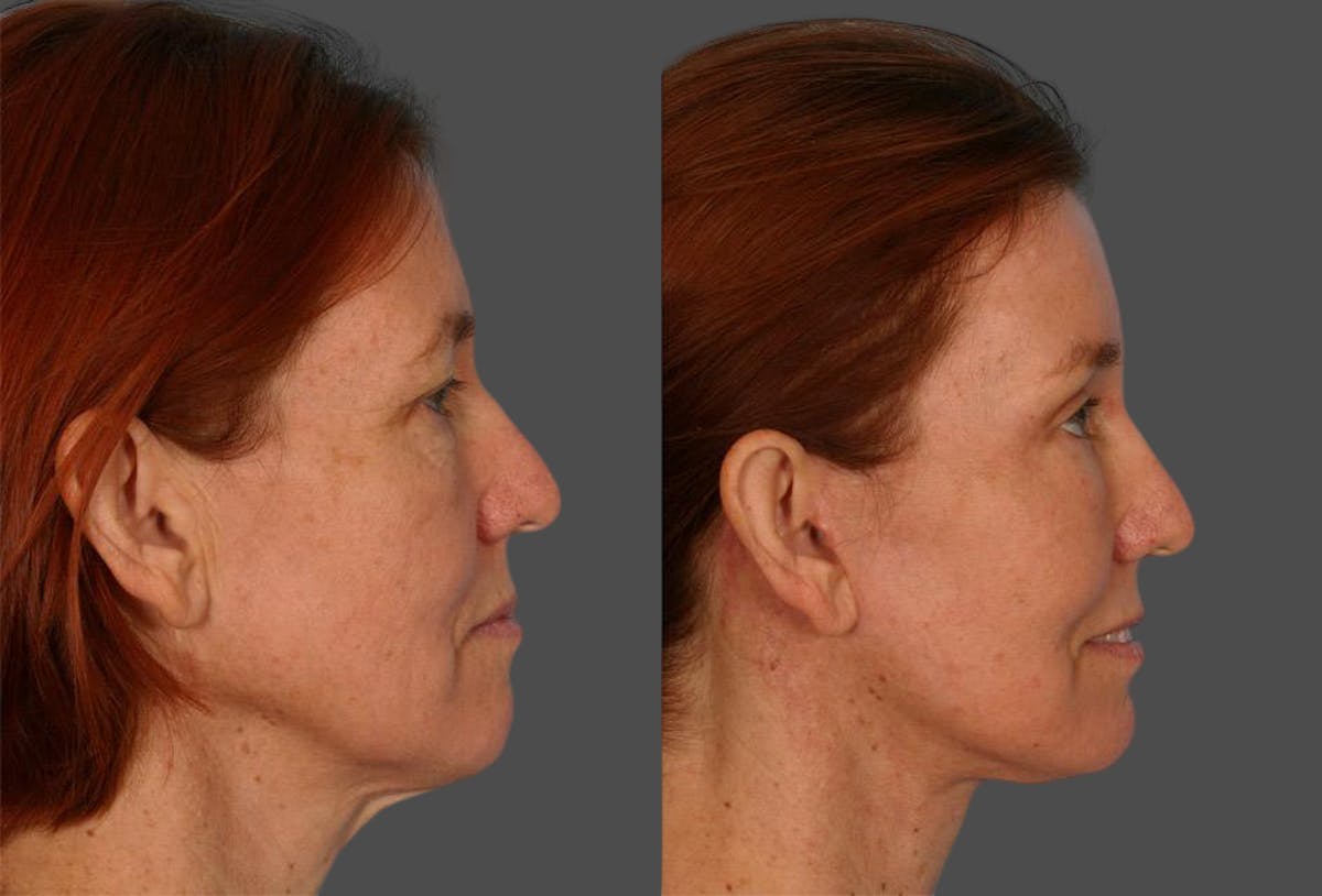 TCA Peel / Dermabrasion Before & After Gallery - Patient 141969 - Image 3