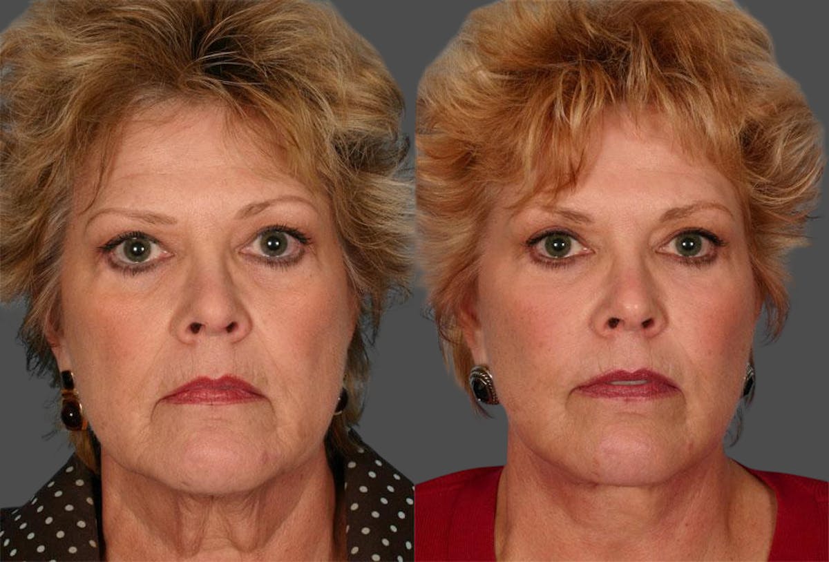 TCA Peel / Dermabrasion Before & After Gallery - Patient 135002 - Image 1