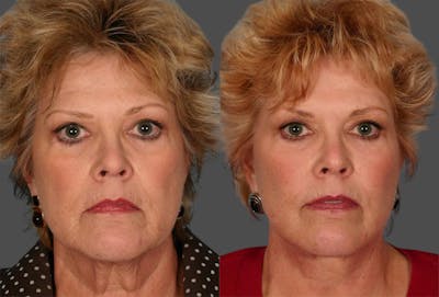 TCA Peel / Dermabrasion Before & After Gallery - Patient 135002 - Image 1
