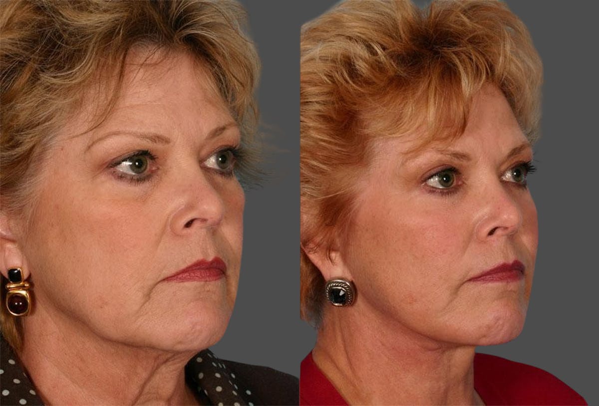 TCA Peel / Dermabrasion Before & After Gallery - Patient 135002 - Image 2