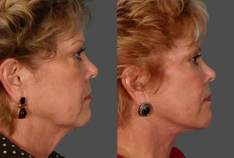 TCA Peel / Dermabrasion Before & After Gallery - Patient 135002 - Image 3