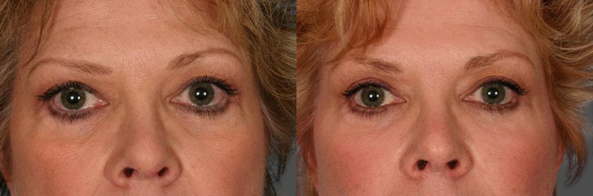 TCA Peel / Dermabrasion Before & After Gallery - Patient 135002 - Image 4