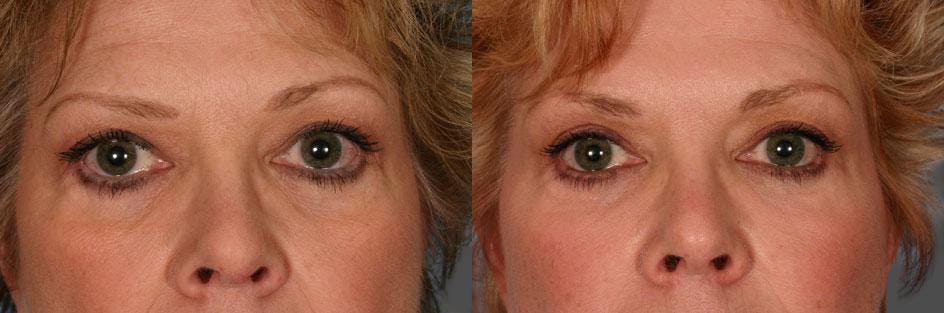 TCA Peel / Dermabrasion Before & After Gallery - Patient 135002 - Image 4