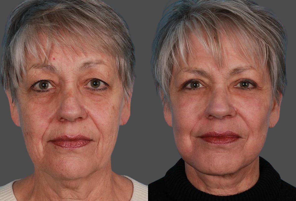 TCA Peel / Dermabrasion Before & After Gallery - Patient 338409 - Image 1