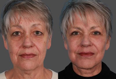 TCA Peel / Dermabrasion Before & After Gallery - Patient 338409 - Image 1