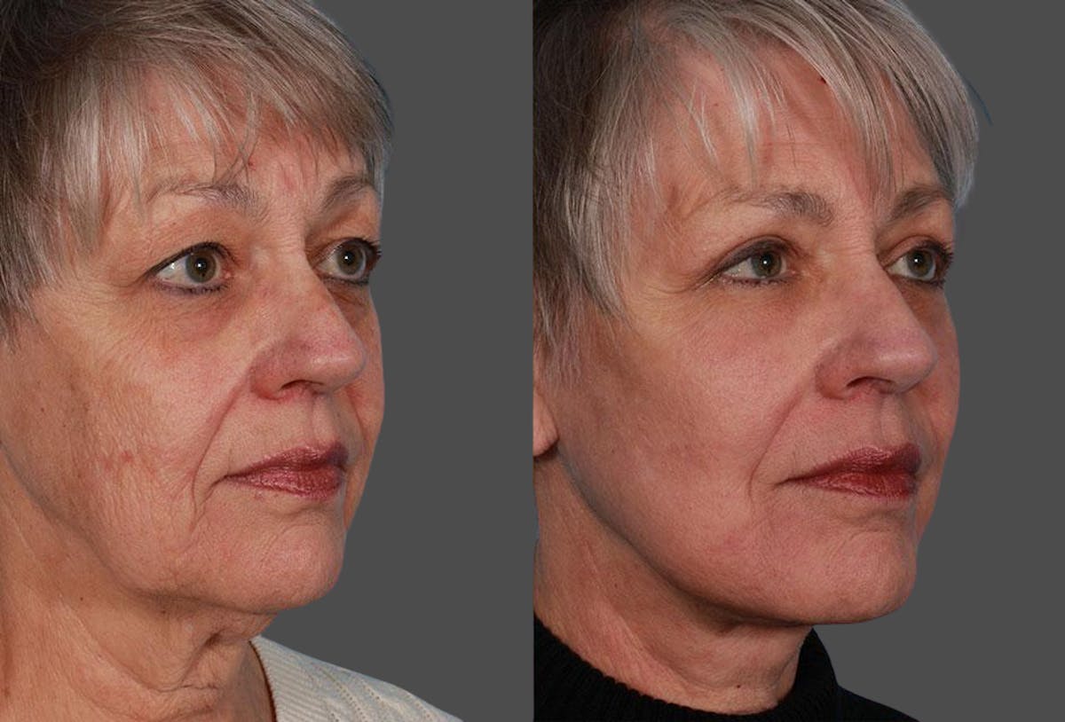 TCA Peel / Dermabrasion Before & After Gallery - Patient 338409 - Image 2