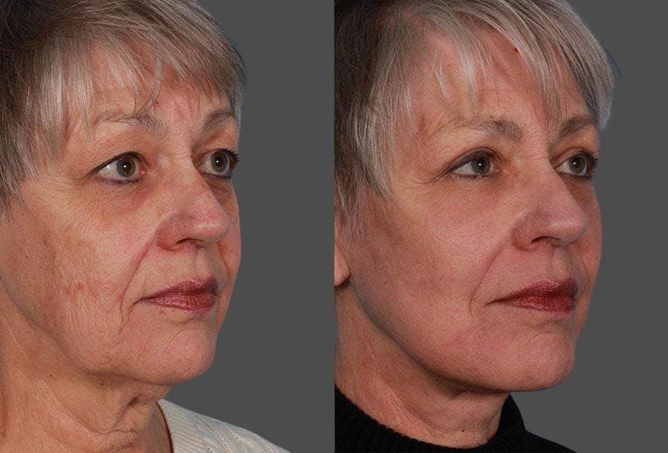 TCA Peel / Dermabrasion Before & After Gallery - Patient 338409 - Image 2