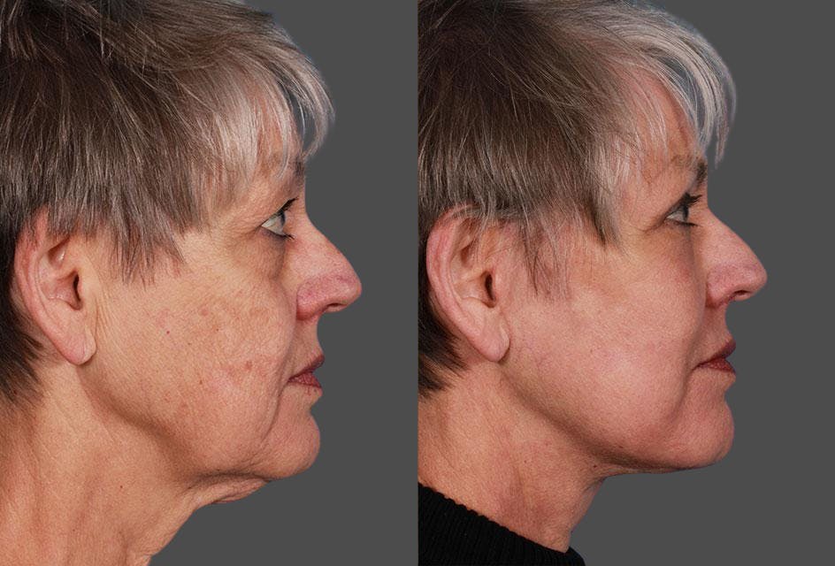 TCA Peel / Dermabrasion Before & After Gallery - Patient 338409 - Image 3