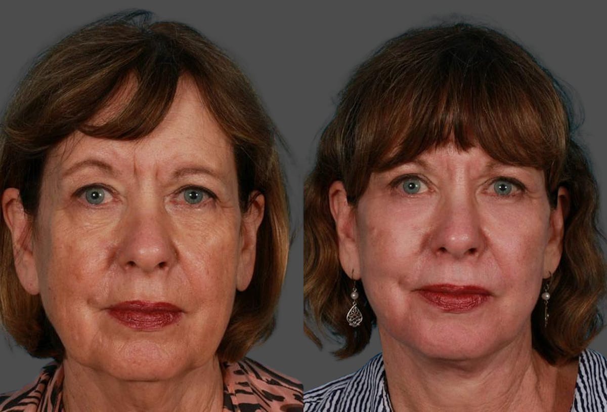 TCA Peel / Dermabrasion Before & After Gallery - Patient 121560 - Image 1