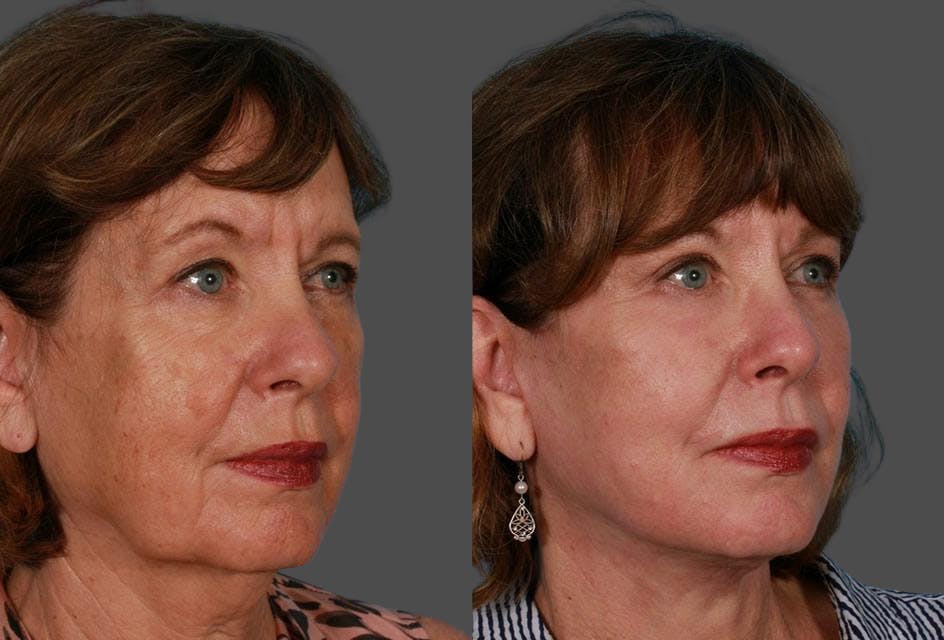 TCA Peel / Dermabrasion Before & After Gallery - Patient 121560 - Image 2