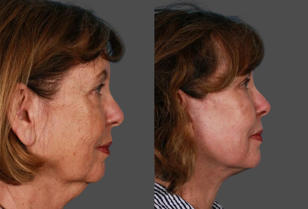 TCA Peel / Dermabrasion Before & After Gallery - Patient 121560 - Image 3
