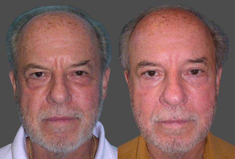 TCA Peel / Dermabrasion Before & After Gallery - Patient 422399 - Image 1