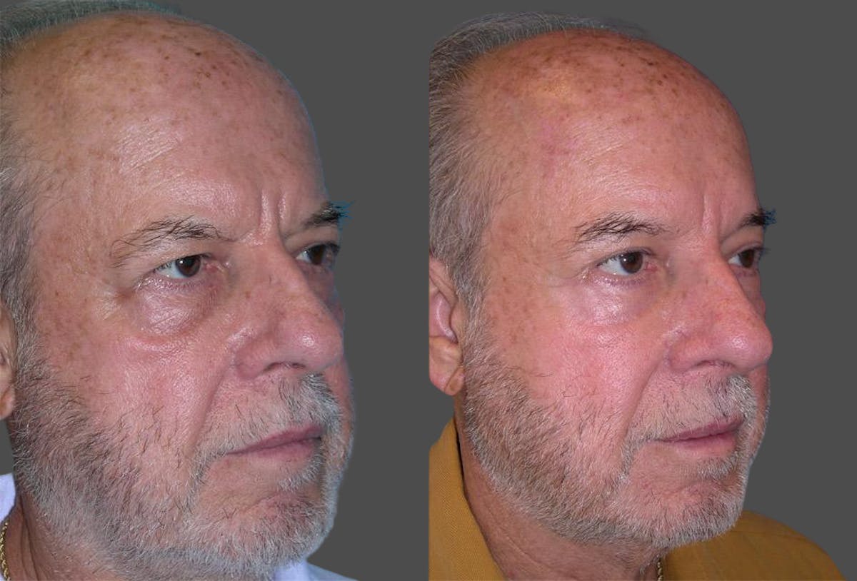 TCA Peel / Dermabrasion Before & After Gallery - Patient 422399 - Image 2