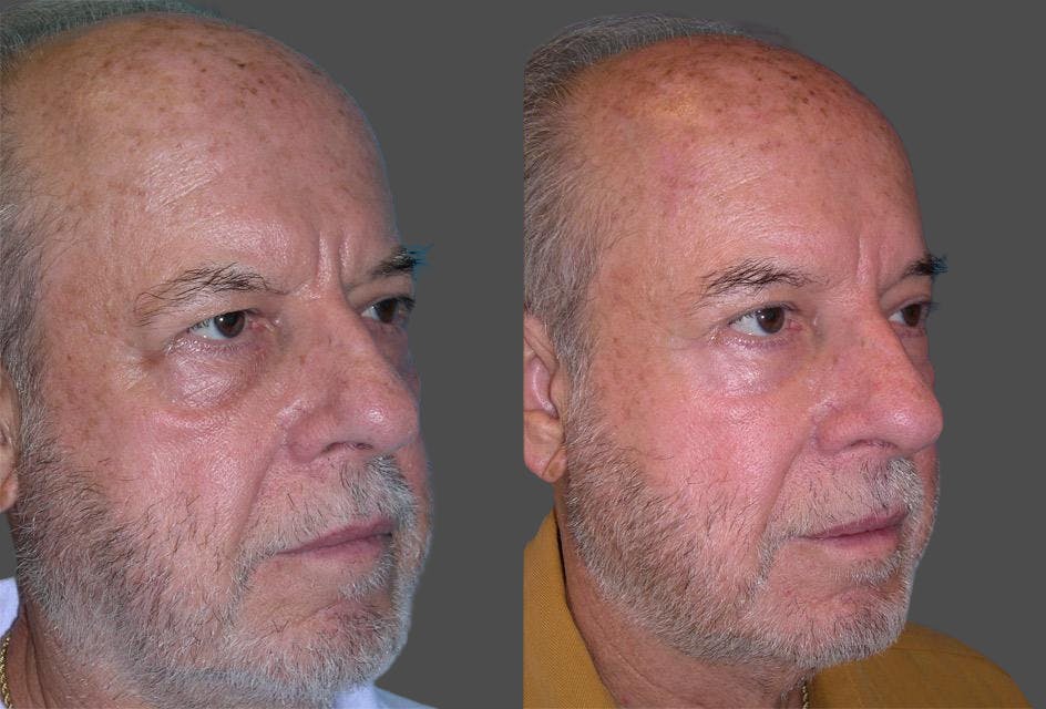 TCA Peel / Dermabrasion Before & After Gallery - Patient 422399 - Image 2