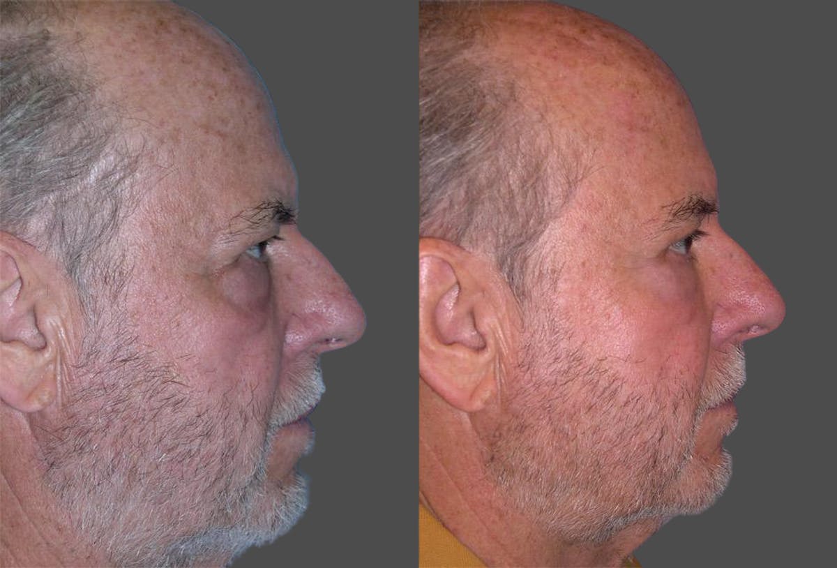 TCA Peel / Dermabrasion Before & After Gallery - Patient 422399 - Image 3