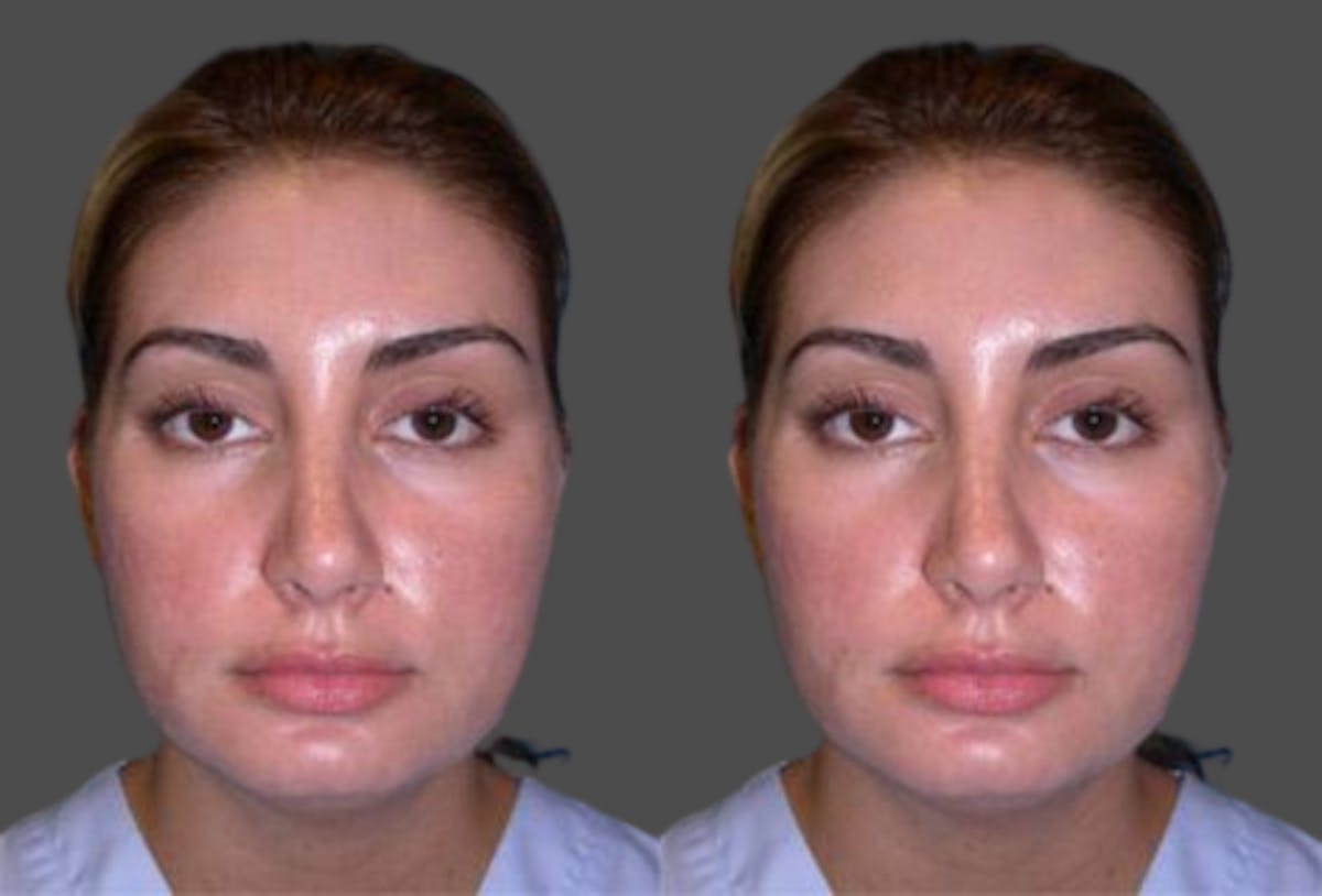 TCA Peel / Dermabrasion Before & After Gallery - Patient 432232 - Image 1