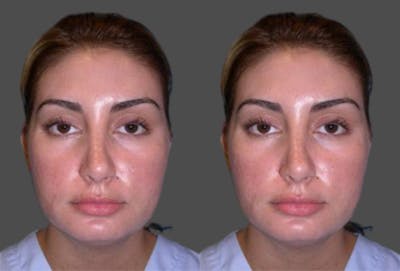 TCA Peel / Dermabrasion Before & After Gallery - Patient 432232 - Image 1