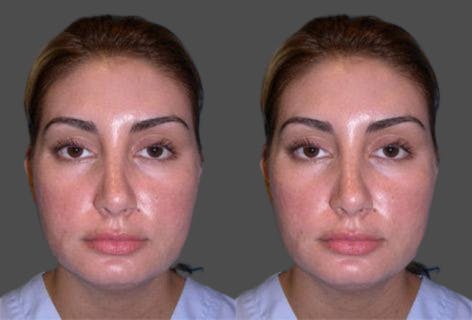 TCA Peel / Dermabrasion Before & After Gallery - Patient 432232 - Image 1