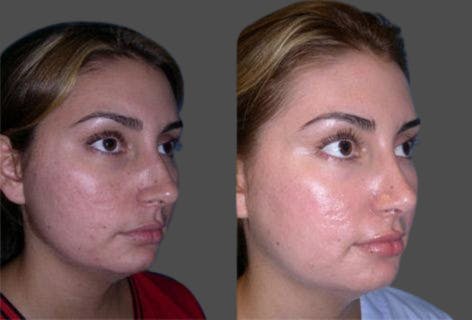 TCA Peel / Dermabrasion Before & After Gallery - Patient 432232 - Image 2