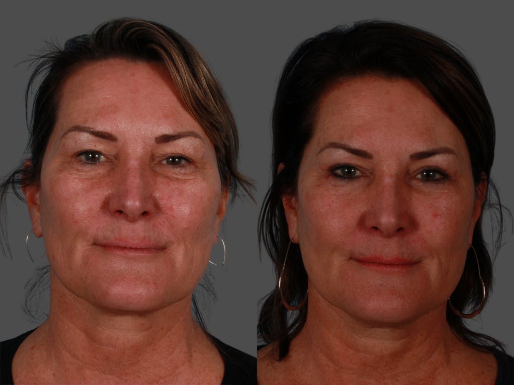 TCA Peel / Dermabrasion Before & After Gallery - Patient 198571 - Image 1