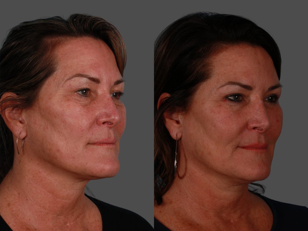 TCA Peel / Dermabrasion Before & After Gallery - Patient 198571 - Image 2