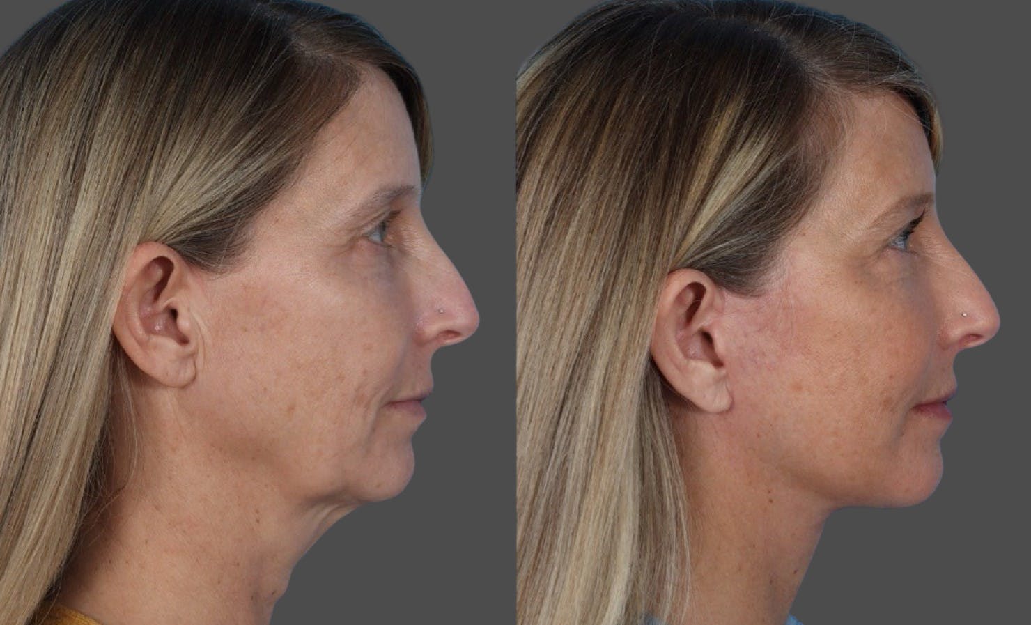 Microliposuction Before & After Gallery - Patient 273120 - Image 3