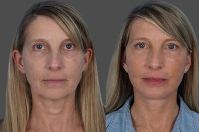 Microliposuction Before & After Gallery - Patient 273120 - Image 1